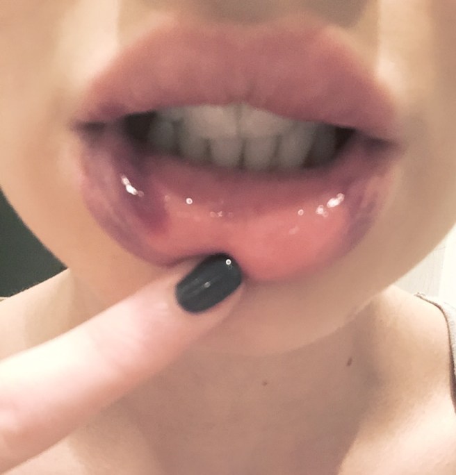 juvederm filler bruising  week 1